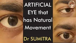 ARTIFICIAL EYE that has Natural Movement Forever | Dr Sumitra