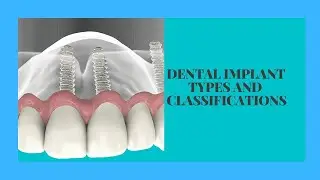 Dental Implant Types  And Classifications