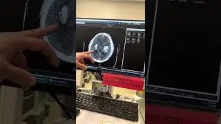 Feb 13, 2024 Brain Scan (MRI). Blood Clot on Both Sides of the Brain