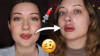 ''PAINLESS'' LIP FILLER HEALING PROCESS | Hyaluron Pen | GLAM_DIARY