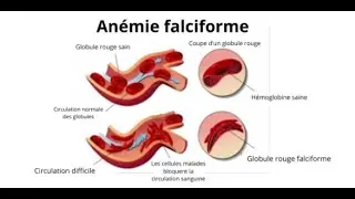 Hematologie - Drepanocytose (Anemie falciforme) [FMPC]