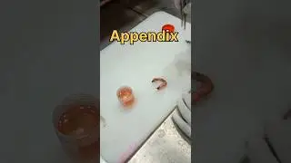 Appendix specimen 🧐👀✂️😭 | #appendicitis #acuteappendix #thyroiddisorders #appendicularskeleton #lab