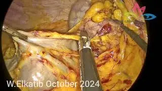 Laparoscopic Whipple 3 (Pancreaticoduodenectomy) with Difficult hot pancreas