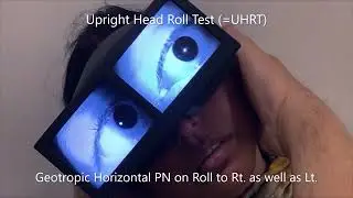 Upright BPPV Protocol in Geotropic Horizontal Canal BPPV