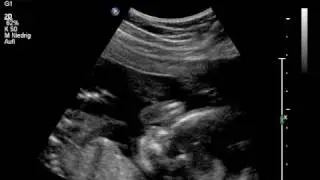 Baby Ultraschall 20. SSW - it's a girl :)