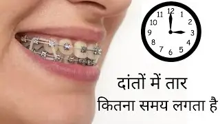 दांतों को अंदर करने में कितना समय लगता है, How long do braces take for Gap/ crowded/ Outward teeth