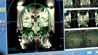 Incisionless procedure to treat tremors offered at Lifespan&rsquo;s Rhode Island Hospital