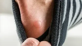 The Basics: Should You Pop a Blister? | WebMD