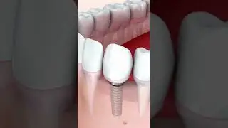 Regain your complete, natural smile! 😄