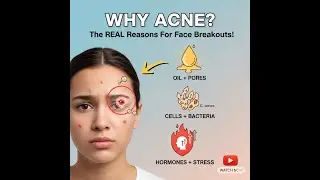 Reasons of Acne on Face