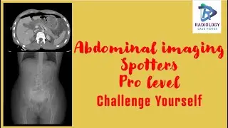Abdomen imaging spotters PRO level challenge yourself#FRCR Spots#Edir Spots# Turtle back liver#