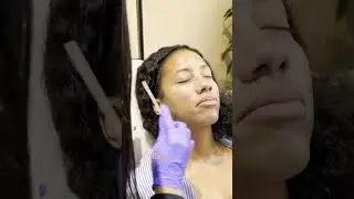 How Laser Skin Resurfacing Prevents Aging BEFORE It Starts! | La Jolla Cosmetic