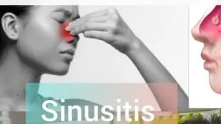 Sinusitis|Homeopathictreatment|Nasalobstruction|Congestion|Facialpain|Causes|Symptoms|Getnaturalcure