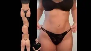 We make sure every patient gets  #SmartPlasticSurgery #DrZach #BodyTransformation #BBL #Lipo360