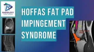 Hoffa's fatpad impingement syndrome#Patellar tendon lateralfemoral frictionrub #Anterior Knee pain