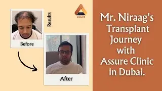 Niraag's Hassle-Free Hair Restoration Journey with Assure: Hear His Story #hairtransplant