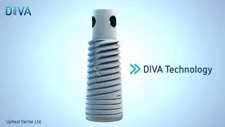 DIVA smart implants - sinus lift technology