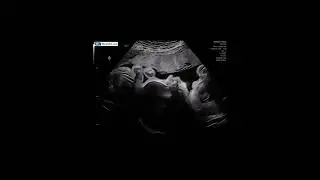 Yawning in utero