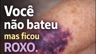 VOCÊ NÃO BATEU, MAS FICOU ROXO. POR QUÊ ?