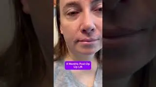 Lip Lift Scars