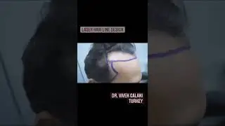Laser Hair Line Design | RQC Hair Transplant Clinic | Dr. Vivek Galani