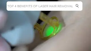 Top 4 Benefits of Laser Hair Removal