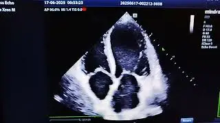 Spontaneous Echo contrast & Left atrial thrombus in severely reduced Ejection Fraction Heart EF20 %
