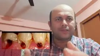 Tooth Coloured filling/Composite Restoration 