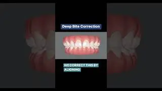 Teeth alignment to correct a deep bite.