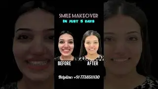 SMILE MAKEOVER IN JUST 5 DAYS #smilemakeover #smile