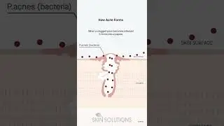 Understanding How Acne Forms: The Science Behind Breakouts