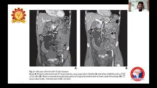 CT Dose Reduction  - Dr. P. Sudhakar