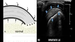 Rotator Cuff Tears diagnosis on Ultrasound