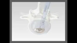 True Position Pivoting TLIF Interbody System - Atlas Spine