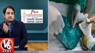 Varicose Veins Problem | Symptoms & Treatment | Dr. Abhilash | Good Health | V6 News