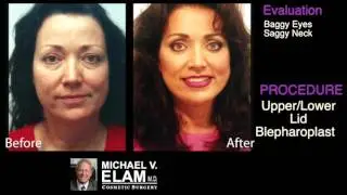 One Woman's Facial Transformation - Dr. Elam's Evaluation - #ElamFirstLook
