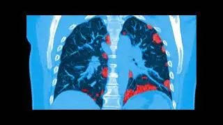 How COVID-19 damages lungs. The virus attacks mitochondria.