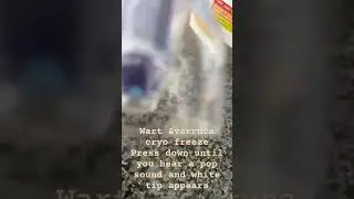 Wart and verruca cryo freeze