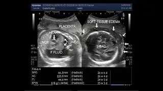 Ultrasound Video showing Hydrops fetalis, Soft tissue edeme, and Fetal pleural effusion.