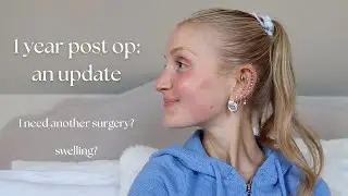 1 Year Post Rhinoplasty: An Update