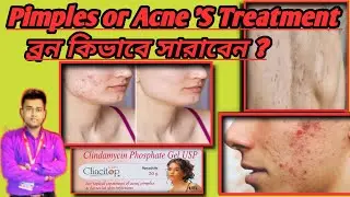 ব্রন কিভাবে ভালো করবেন? সঠিক নিয়মে ব্যবহার করুন/Clincitop Gel use in Bangla