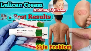 Lulican Cream | Luliconazole Cream Antifungal medicine | Lulican cream uses in hindi