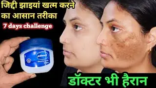 7 दोनों में जिद्दी काली झाइयां जड़ से खत्म // Reduce Melasma, Pigmentation, Discolouration 