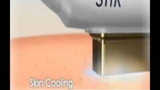 KAE Clinic Super Hair Removal Introduction