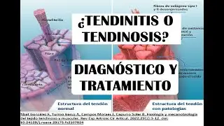 TENDINITIS O TENDINOSIS? COMO DIFERENCIARLO Y TRATARLO