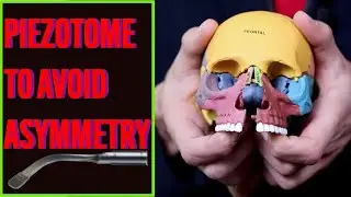 Avoid MSE (MARPE) Uncertainty with Piezotome Surgical Assist