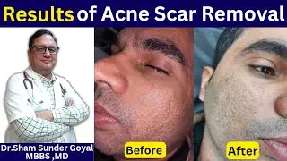 Acne Scar Treatment | Result | Home Treatment | Laser Cost | Pimple Scars