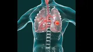 Overview of Management of Non Metastatic Non Small Cell Lung Cancer
