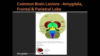 Common Brain Lesions - Amygdala, Frontal & Parietral Lobe