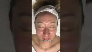Salicylic acid, Lactic acid, Glycolic acid Peel